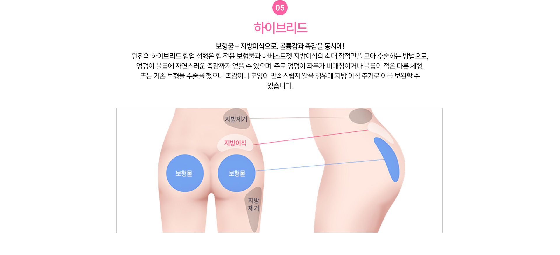 하이브리드
				보형물 + 지방이식으로, 볼륨감과 촉감을 동시에!
원진의 하이브리드 힙업 성형은 힙 전용 보형물과 하베스트젯 지방이식의 최대 장점만을 모아 수술하는 방법으로,
엉덩이 볼륨에 자연스러운 촉감까지 얻을 수 있으며, 주로 엉덩이 좌우가 비대칭이거나 볼륨이 적은 마른 체형,
또는 기존 보형물 수술을 했으나 촉감이나 모양이 만족스럽지 않을 경우에 지방 이식 추가로 이를 보완할 수 있습니다.
		POINT	
		개인에 맞는 고정점을 찾아, 당기는 각도와 방향을 섬세하게 조절하여
위치 별로 다양한 실을 복합적으로 사용하는 것이 디테일!
		