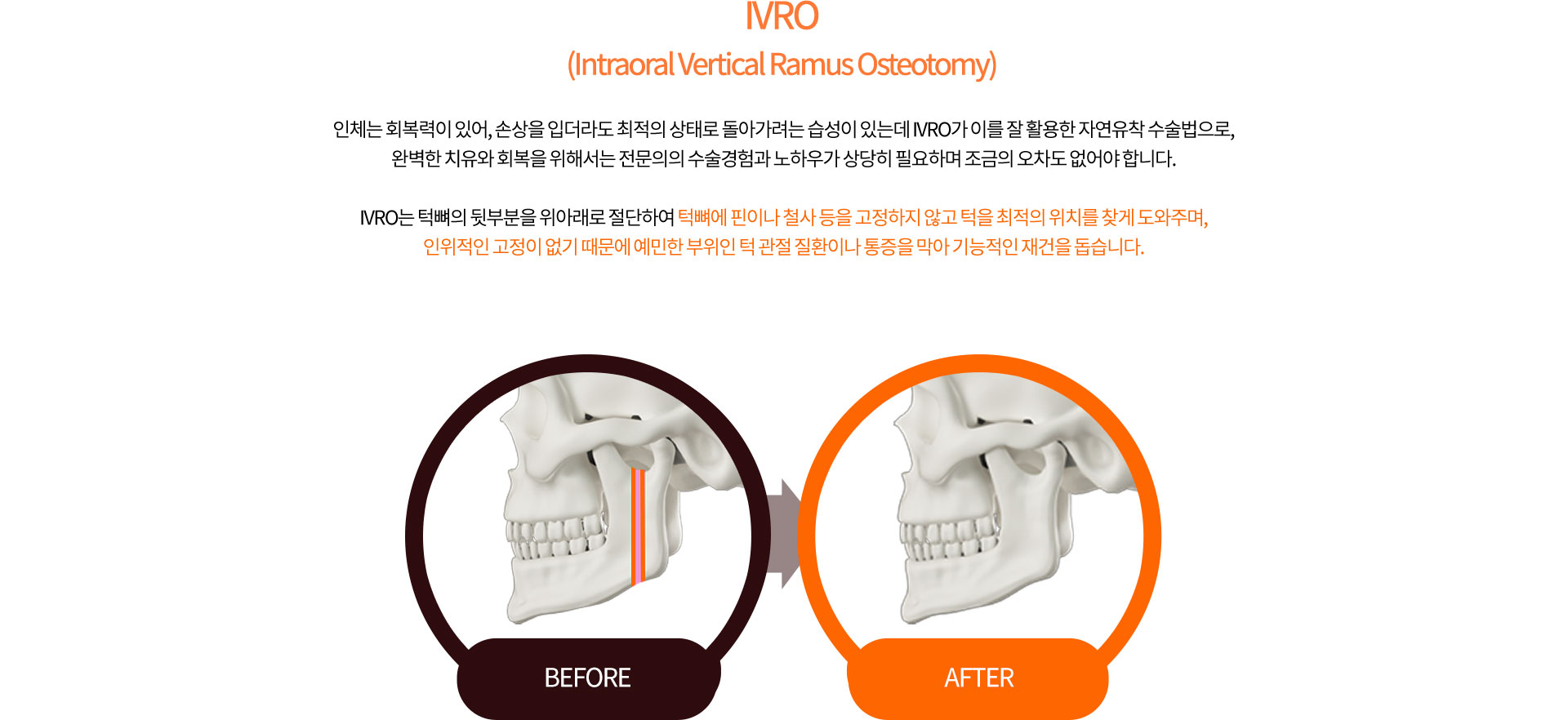 IVRO (Intraoral Vertical Ramus Osteotomy)
		인체는 회복력이 있어, 손상을 입더라도 최적의 상태로 돌아가려는 습성이 있는데 IVRO가 이를 잘 활용한 자연유착 수술법으로,
		완벽한 치유와 회복을 위해서는 전문의의 수술경험과 노하우가 상당히 필요하며 조금의 오차도 없어야 합니다.

		IVRO는 턱뼈의 뒷부분을 위아래로 절단하여 턱뼈에 핀이나 철사 등을 고정하지 않고 턱을 최적의 위치를 찾게 도와주며,
		인위적인 고정이 없기 때문에 예민한 부위인 턱 관절 질환이나 통증을 막아 기능적인 재건을 돕습니다.
		