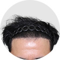 모발이식 이미지