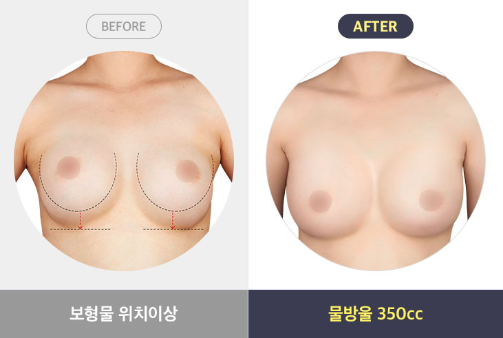 보형물 위치이상 - 물방울 350cc