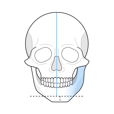 턱이 비대칭인 사각 턱 수술과정 이미지1