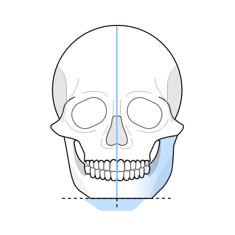 턱이 비대칭인 사각 턱 수술과정 이미지2