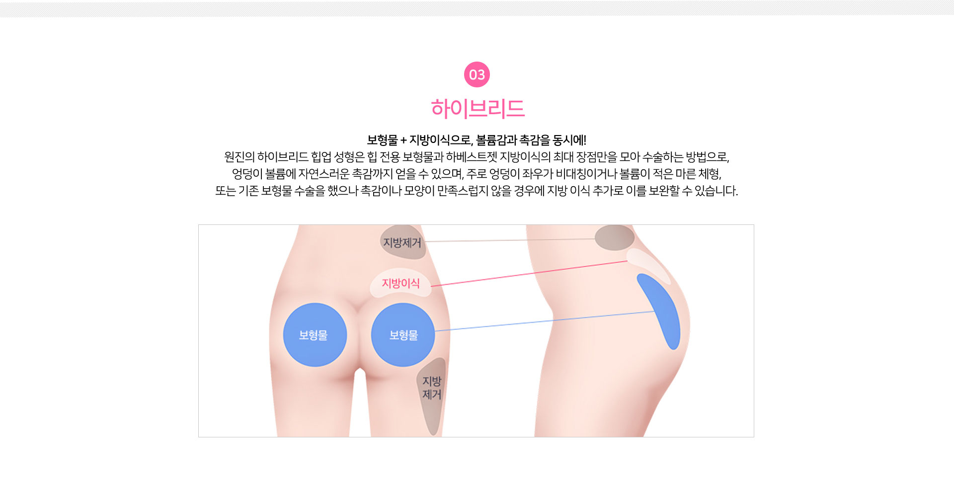 하이브리드
				보형물 + 지방이식으로, 볼륨감과 촉감을 동시에!
원진의 하이브리드 힙업 성형은 힙 전용 보형물과 하베스트젯 지방이식의 최대 장점만을 모아 수술하는 방법으로,
엉덩이 볼륨에 자연스러운 촉감까지 얻을 수 있으며, 주로 엉덩이 좌우가 비대칭이거나 볼륨이 적은 마른 체형,
또는 기존 보형물 수술을 했으나 촉감이나 모양이 만족스럽지 않을 경우에 지방 이식 추가로 이를 보완할 수 있습니다.
		POINT	
		개인에 맞는 고정점을 찾아, 당기는 각도와 방향을 섬세하게 조절하여
위치 별로 다양한 실을 복합적으로 사용하는 것이 디테일!
		