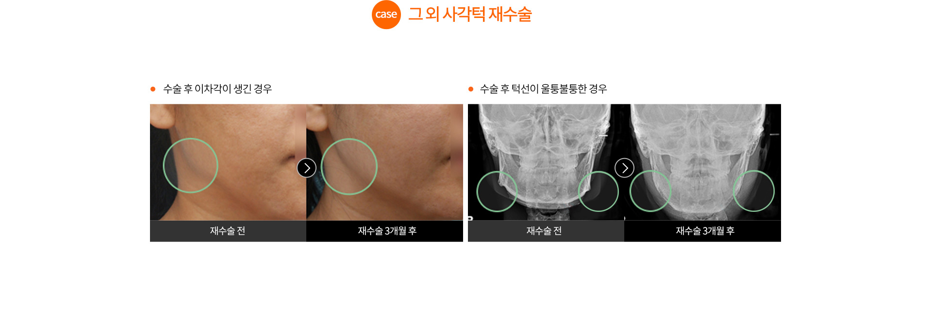 case.그 외 사각턱 재수술