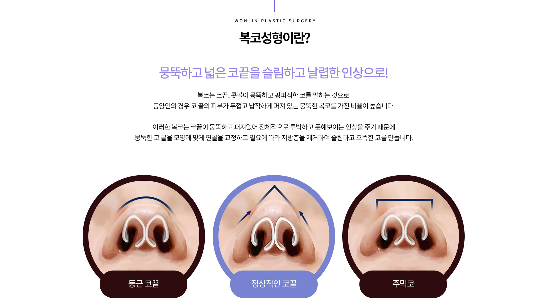 복코성형이란?
				뭉뚝하고 넓은 코끝을 슬림하고 날렵한 인상으로!

복코는 코끝, 콧볼이 뭉뚝하고 펑퍼짐한 코를 말하는 것으로 
동양인의 경우 코 끝의 피부가 두껍고 납작하게 퍼져 있는 뭉뚝한 복코를 가진 비율이 높습니다.

이러한 복코는 코끝이 뭉뚝하고 퍼져있어 전체적으로 투박하고 둔해보이는 인상을 주기 때문에
뭉뚝한 코 끝을 모양에 맞게 연골을 교정하고 필요에 따라 지방층을 제거하여 슬림하고 오똑한 코를 만듭니다.
정상적인 코끝긑 둥근 코끝 주먹코

