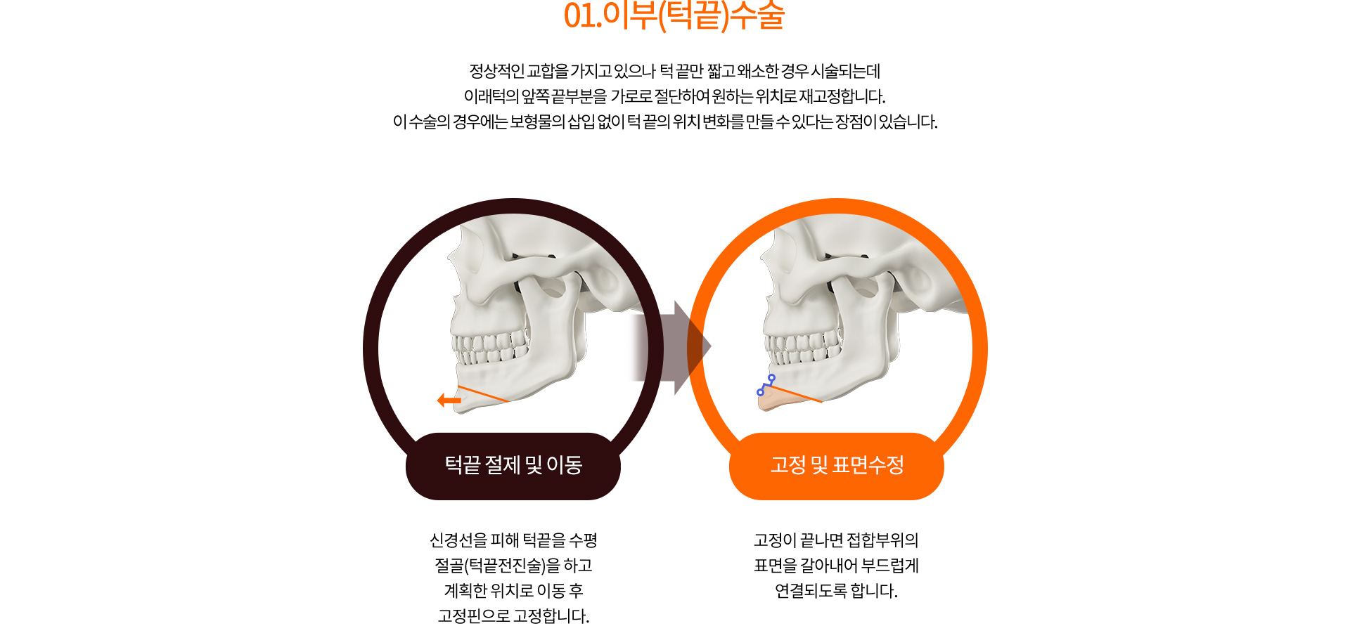 01.이부(턱끝)수술
		정상적인 교합을 가지고 있으나  턱 끝만  짧고 왜소한경우 시술되는데
		이래턱의 앞쪽 끝부분을  가로로 절단하여 원하는 위치로 재고정합니다.
		이 수술의 경우에는 보형물의 삽입 없이 턱 끝의 위치 변화를 만들 수 있다는 장점이 있습니다. 
		턱끝 절제 및 이동
		신경선을 피해 턱끝을 수평 절골(턱끝전진술)을 하고 계획한 위치로 이동 후 고정핀으로 고정합니다.
		고정 및 표면 수정
		고정이 끝나면 접합부위의 표면을 갈아내어 부드럽게 연결되도록 합니다.
		