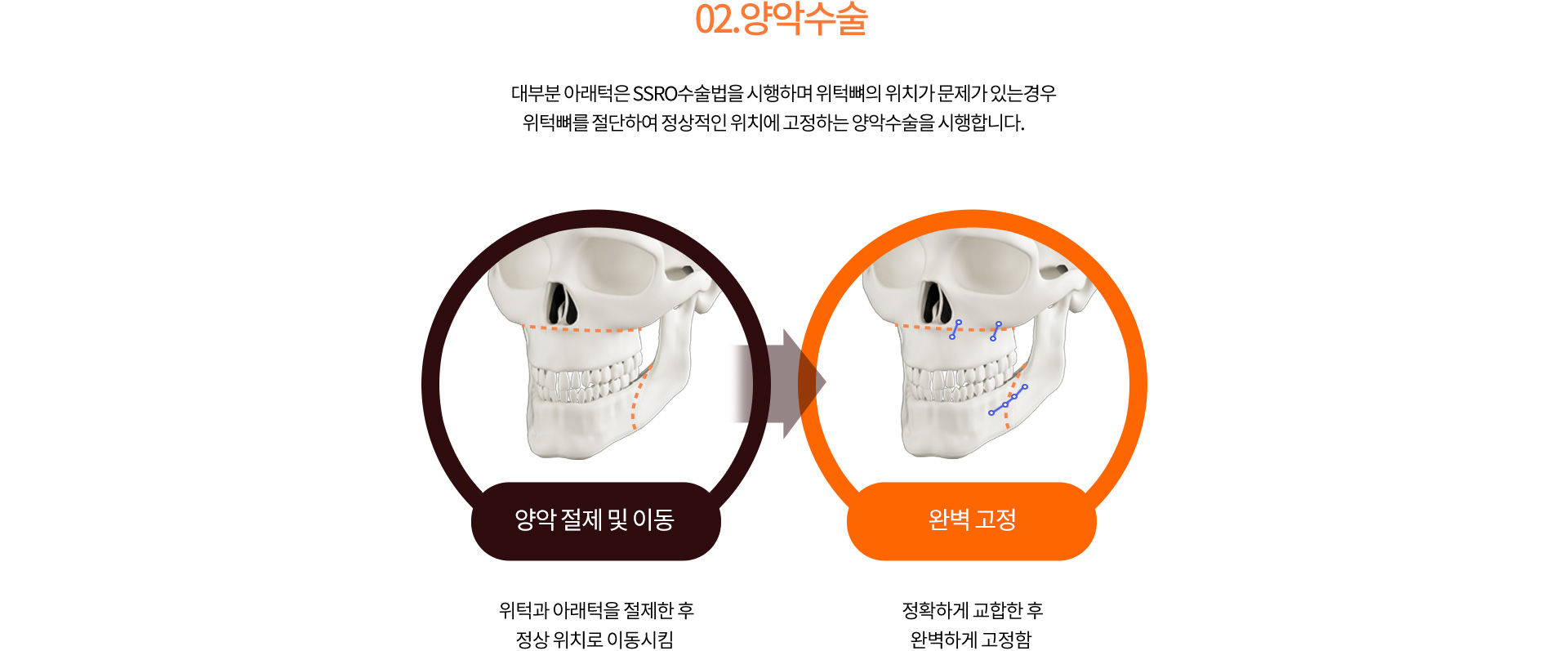 02.양악수술
		대부분 아래턱은 SSRO수술법을 시행하며 위턱뼈의 위치가 문제가 있는경우
		위턱뼈를 절단하여 정상적인 위치에 고정하는 양악수술을 시행합니다.  
		양악 절제 및 이동
		위턱과 아래턱을 절제한 후 정상 위치로 이동시킴 
		완벽 고정
		정확하게 교합한 후 완벽하게 고정함
		