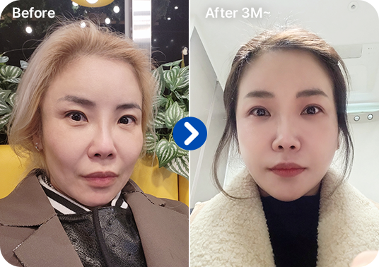 리프팅