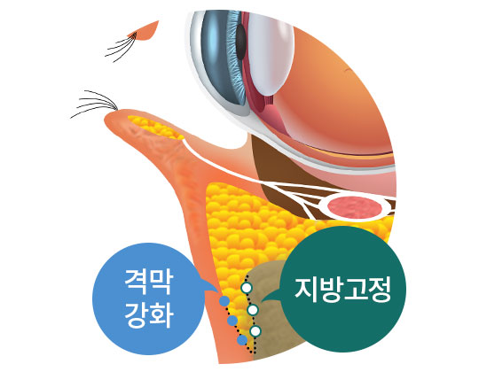 수술 후 변화된 눈매 이미지