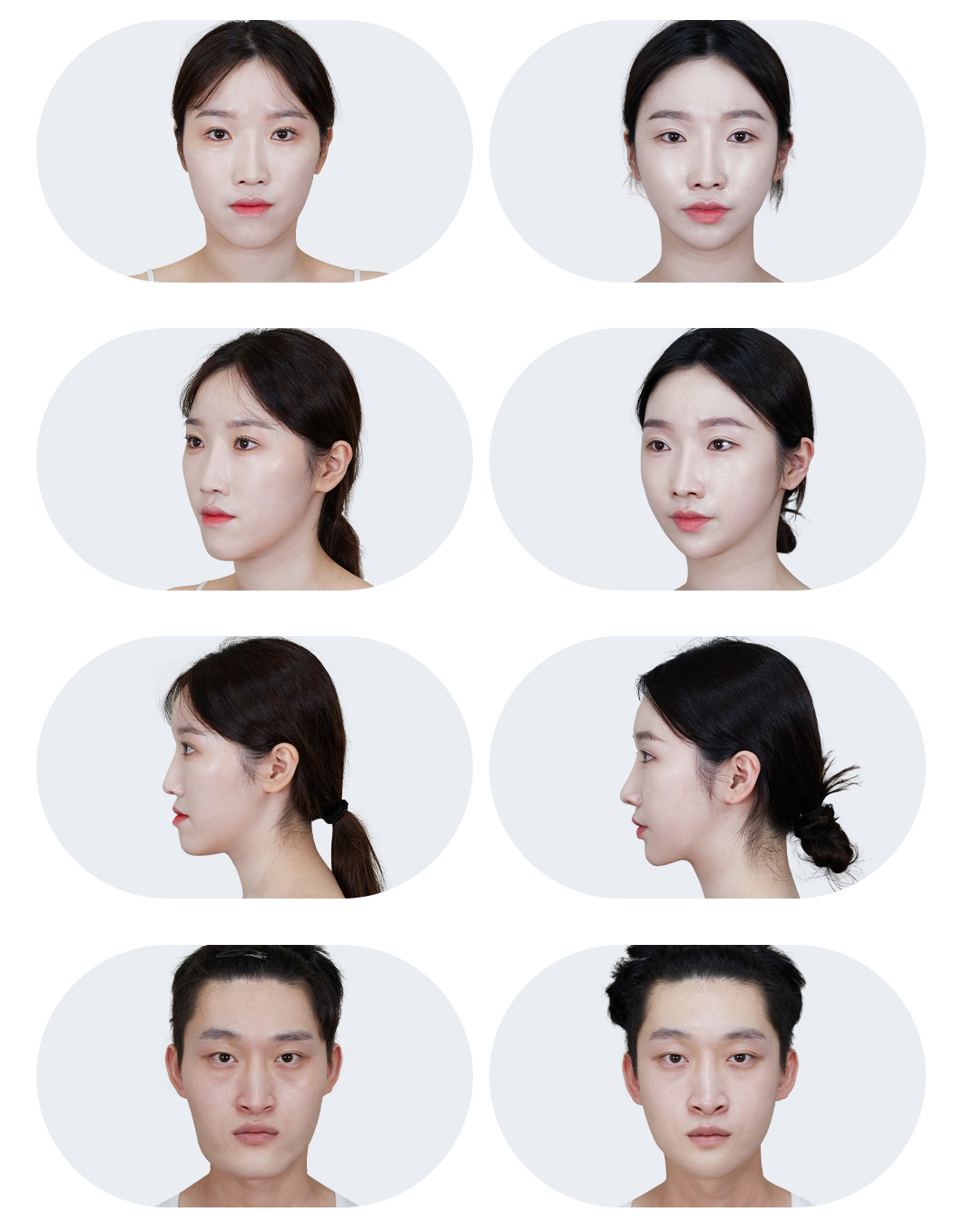 성형 전/후 이미지