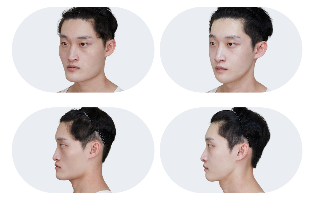 성형 전/후 이미지