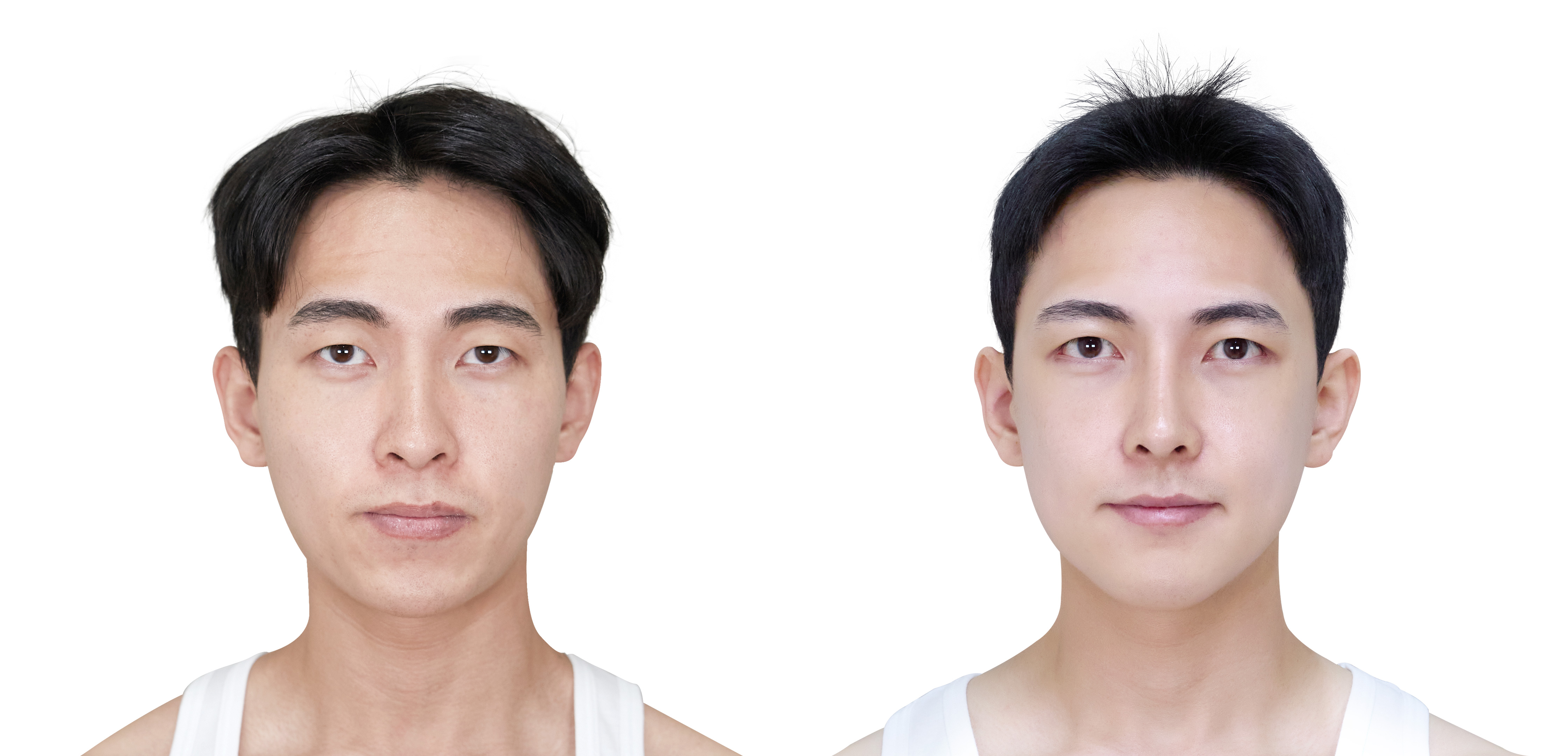 성형 전/후 이미지