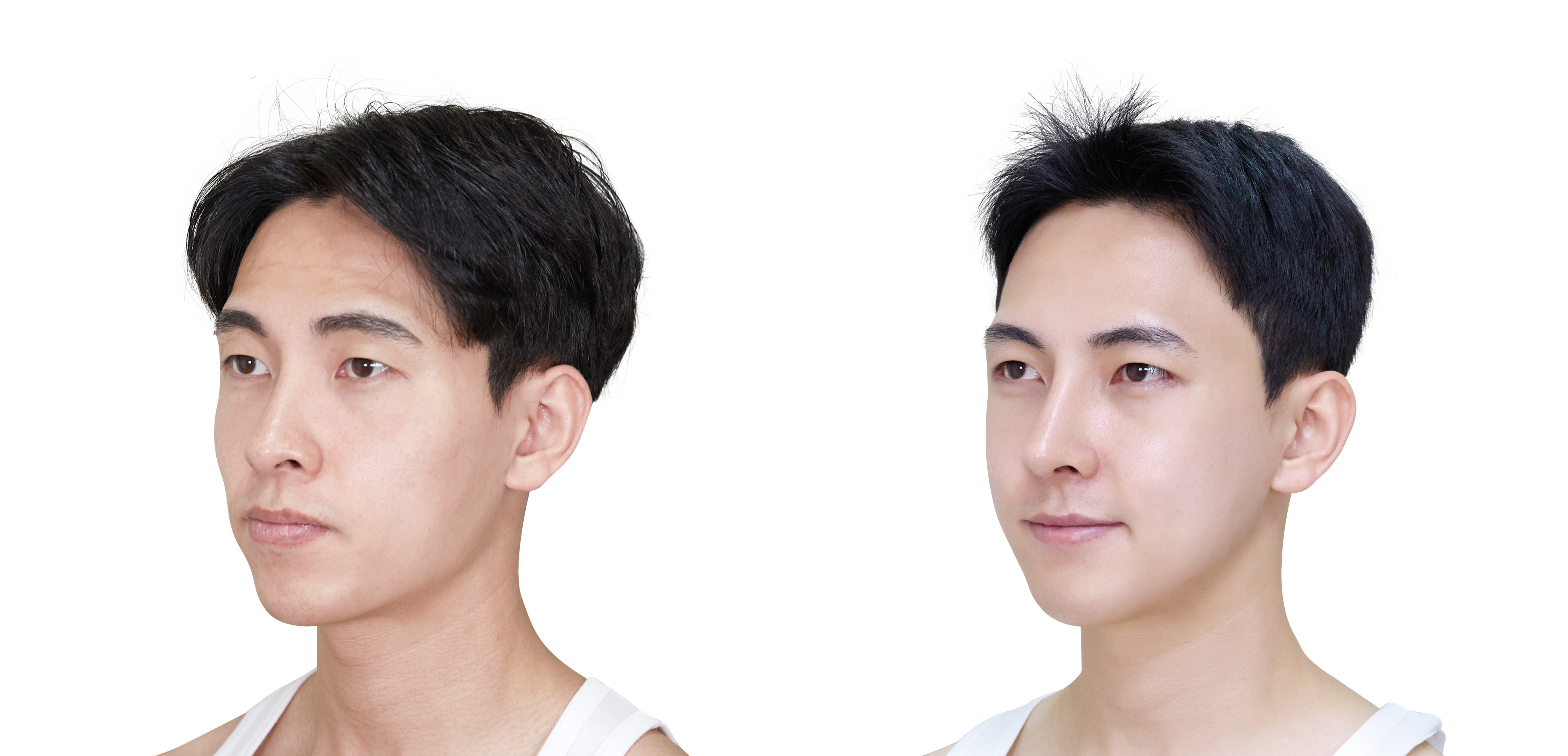 성형 전/후 이미지