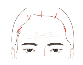 절개 부위 체크