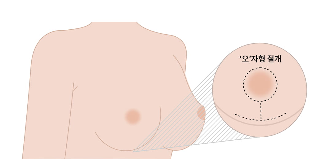‘오’자형 절개법 이미지