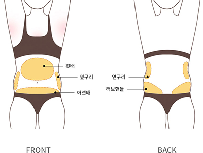 복부 지방 흡입 이미지