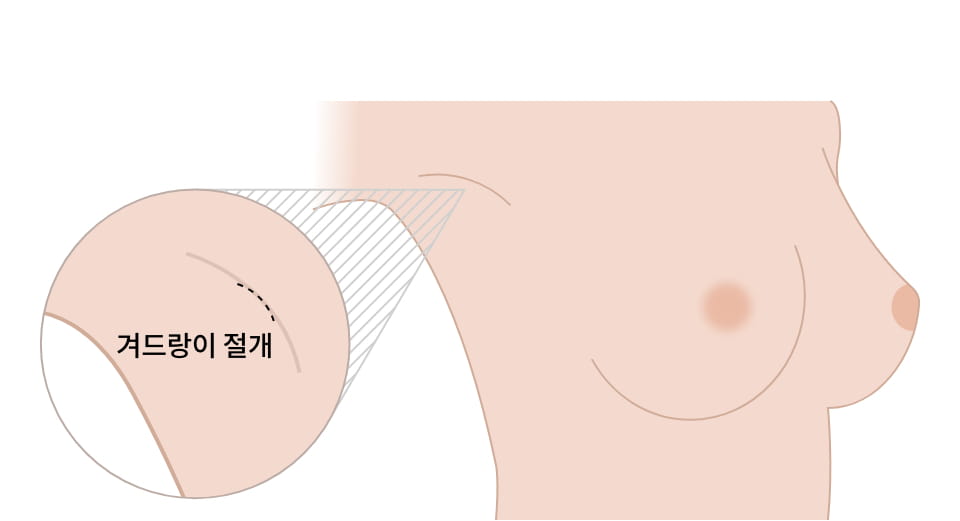 윤곽·양악 갤러리 이미지