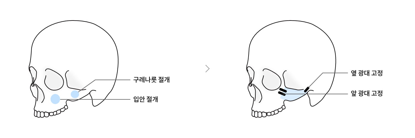 3D 광대 축소술 수술 과정 이미지