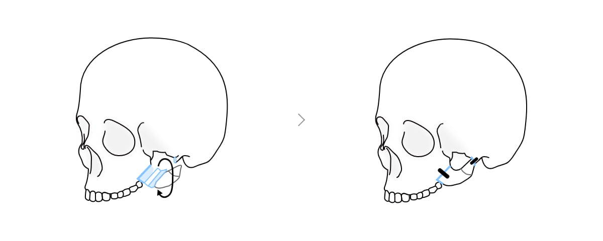 광대뼈 회전 축소술 과정 이미지