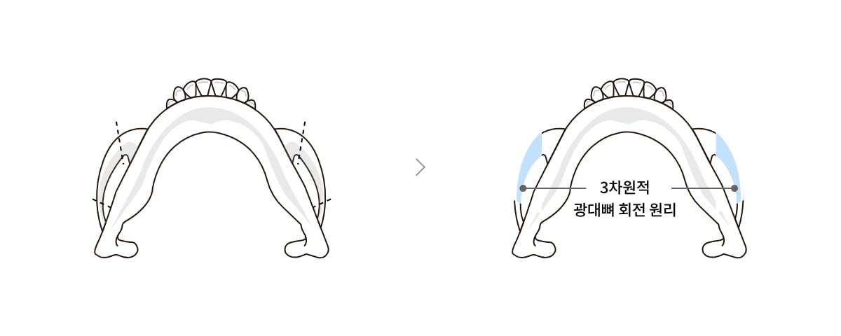 광대뼈 회전 축소술 과정 이미지