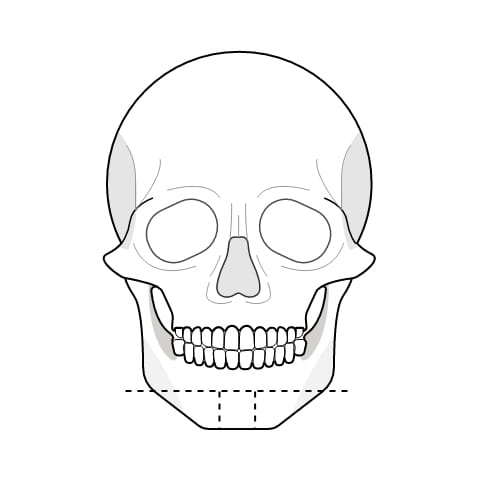 아래턱이 넓은 사각형 수술과정 이미지1