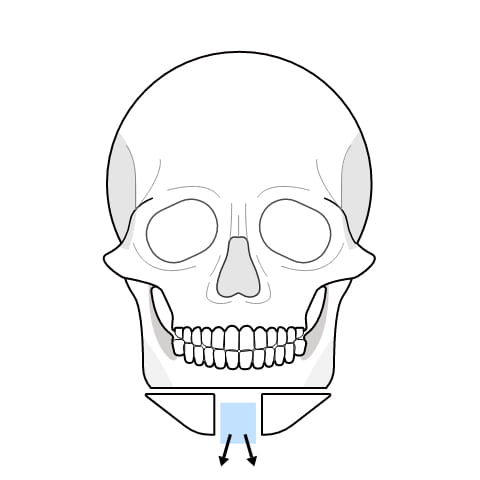 아래턱이 넓은 사각형 수술과정 이미지2