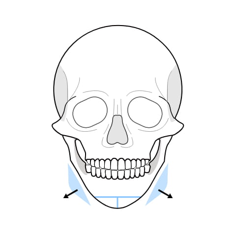 아래턱이 넓은 사각형 수술과정 이미지3