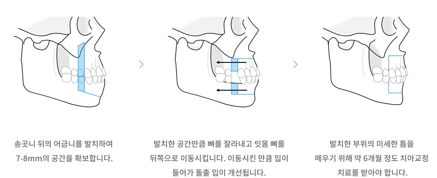 전방분절 절골술 (ASO) 이미지