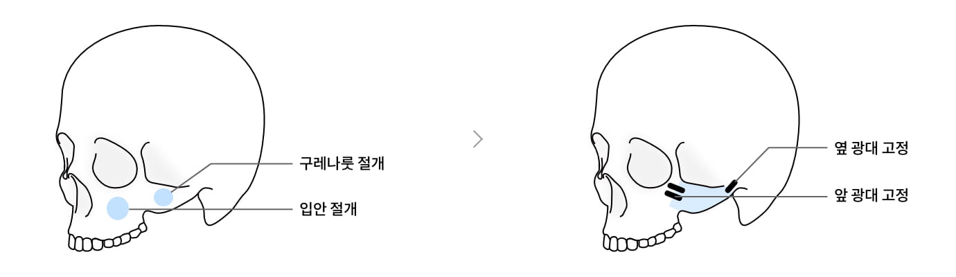 아이퀵 광대 축소술 수술과정 이미지