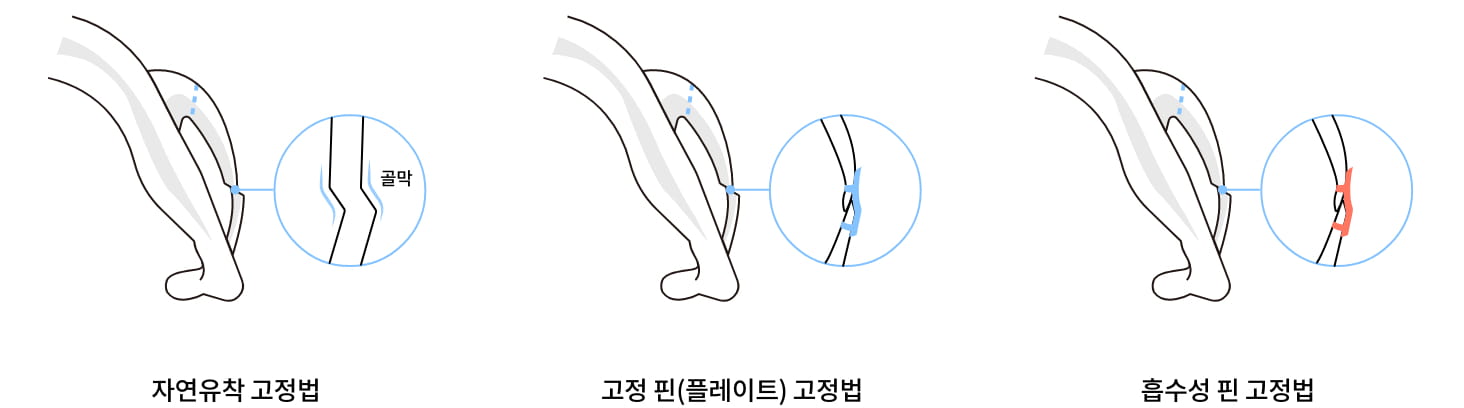 아이퀵 광대 축소술 수술과정 이미지