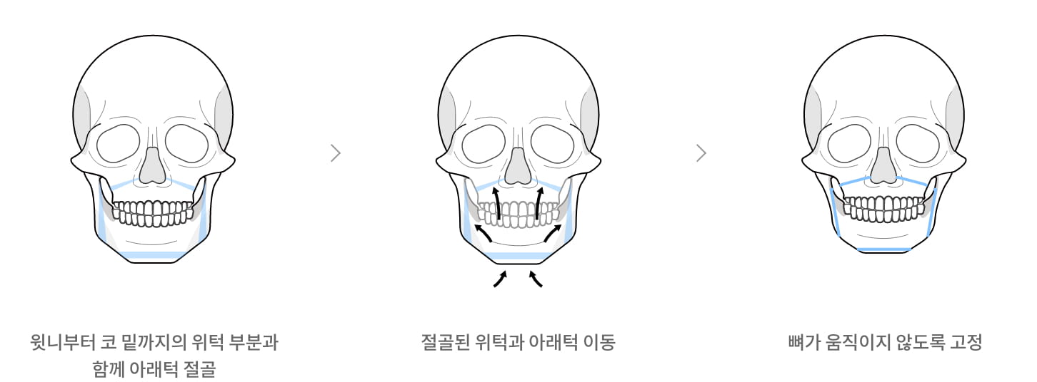 윤곽·양악 갤러리 이미지