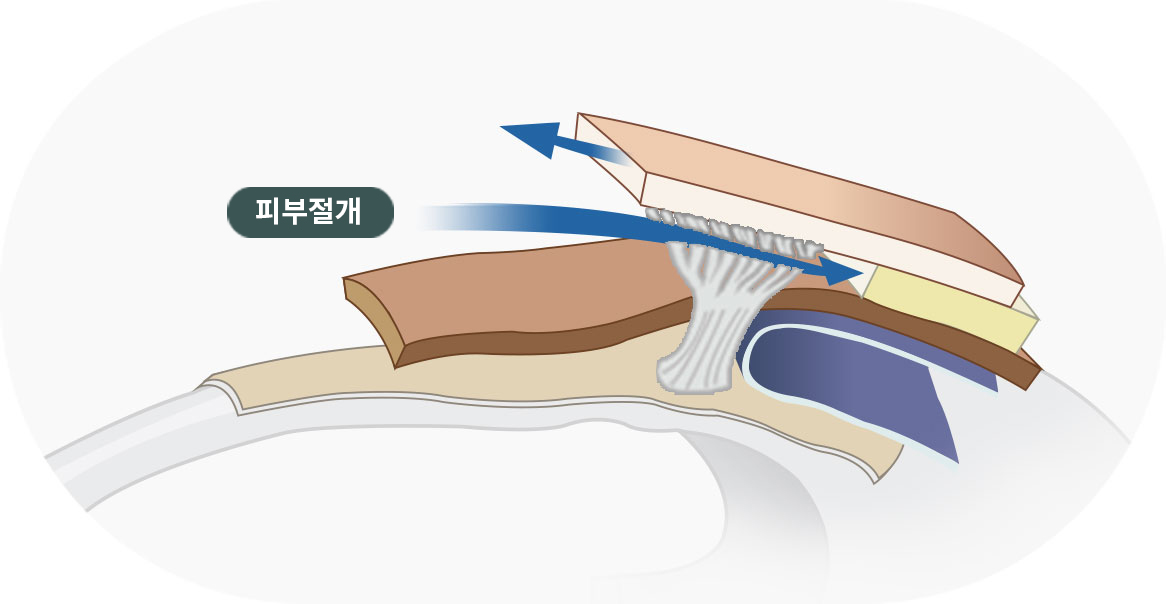 부만 리프팅 하는 경우 이미지