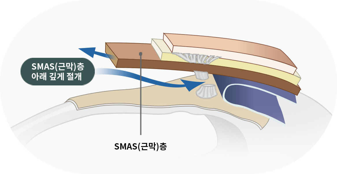 SMAS(근막)층까지 리프팅 하는 WJ 원진 이미지