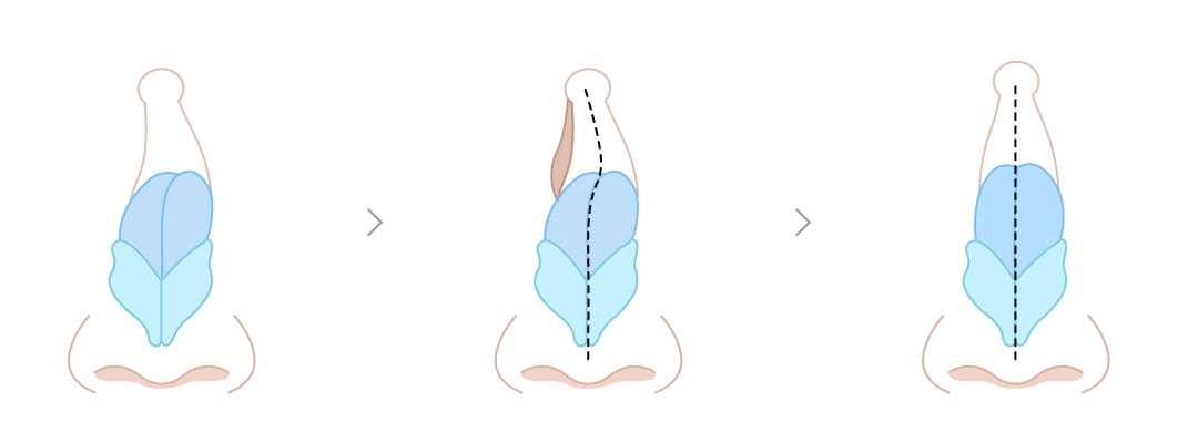 휘어진 정도가 가벼운 경우 이미지