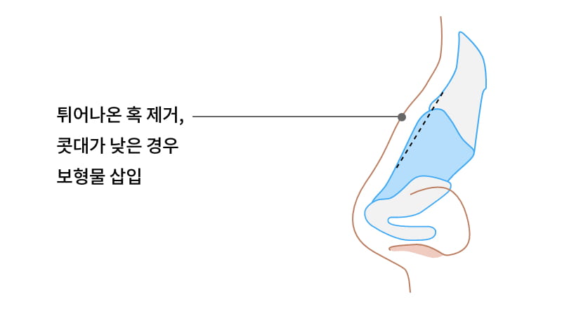 튀어나온 혹 제거, 콧대가 낮은 경우 보형물 삽입 이미지