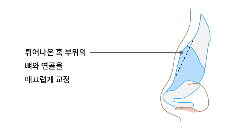 튀어나온 혹 부위의 뼈와 연골을 매끄럽게 교정 이미지