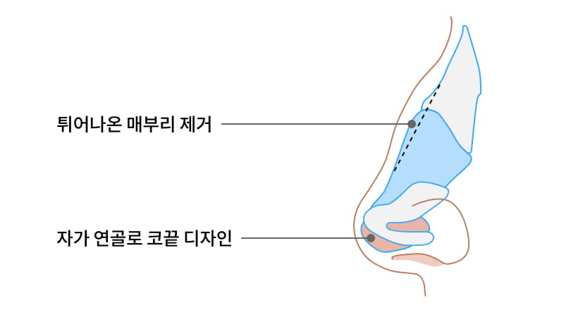 튀어나온 매부리, 자가 연골로 코끝 디자인 이미지