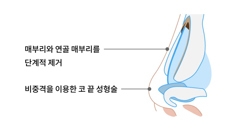 매부리와 연골 매부리를 단계적 제거, 비중격을 이용한 코 끝 성형술 이미지