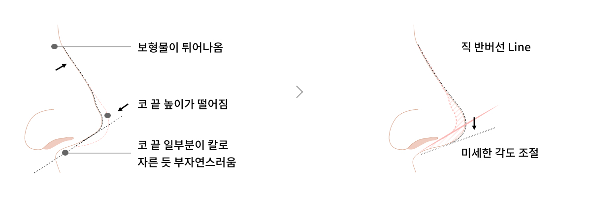 수술 후에도 코 끝의 높이가 유지되지 않고 떨어진 경우 이미지