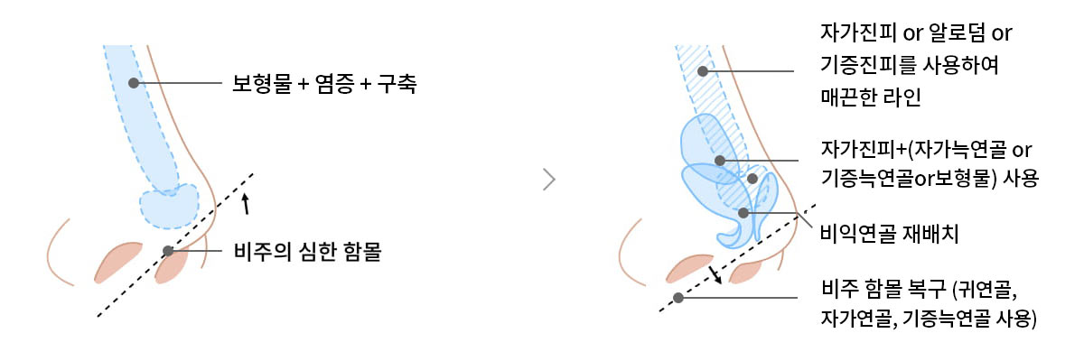 코 끝이 들려 콧구멍이 많이 보이는 경우 이미지