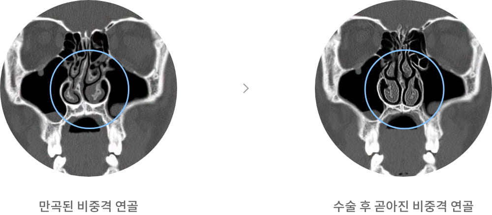 만곡된 비중격 연골 / 수술 후 곧아진 비중격 연골 이미지