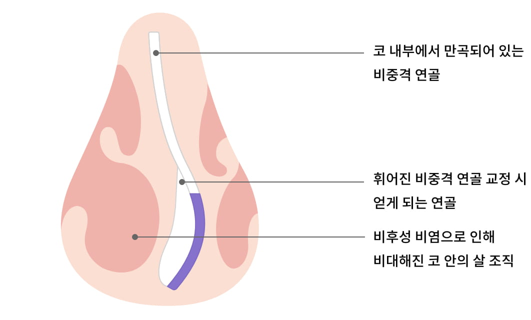 코 내부에서 만곡되어 있는 비중격 연골, 휘어진 비중격 연골 교정 시 얻게 되는 연골, 비후성 비염으로 인해 비대해진 코 안의 살 조직 이미지