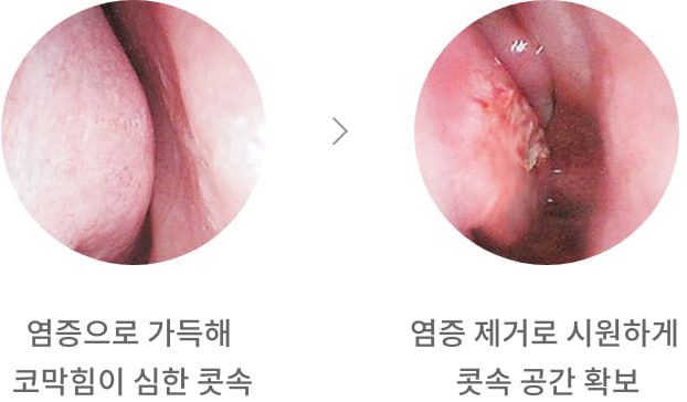 염증으로 가득해 코막힘이 심한 콧속, 염증 제거로 시원하게 콧속 공간 확보 이미지