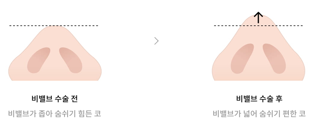 비밸브 수술 전(비밸브가 좁아 숨쉬기 힘든 코), 비밸브 수술 후(비밸브가 넓어 숨쉬기 편한 코) 이미지