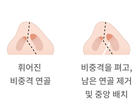 휘어진 비중격 연골 / 비중격을 펴고, 남은 연골 제거 및 중앙 배치 이미지