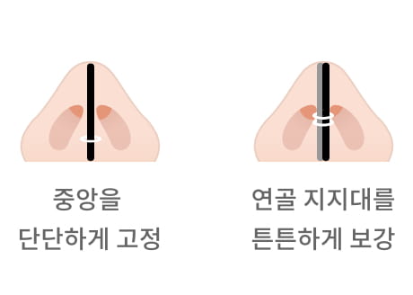 중앙을 단단하게 고정 / 연골 지지대를 튼튼하게 보강한 이미지